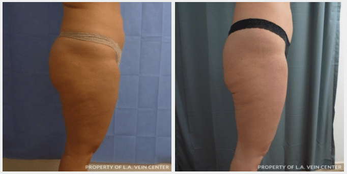 Liposuction Los Angeles