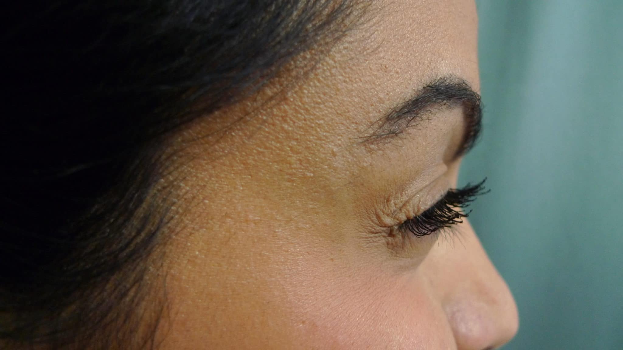 After Xeomin Crows Feet LA Vein Center Sherman Oaks Larisse Lee MD 076