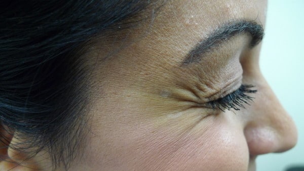 Before Xeomin Crows Feet LA Vein Center Sherman Oaks LArisse Lee MD 076 e1459863932608