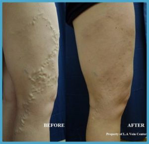 side of patient’s leg before and after varicose vein treatment, bulging vein gone afterwards