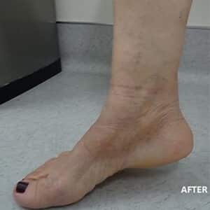 Spider Vein Treatment