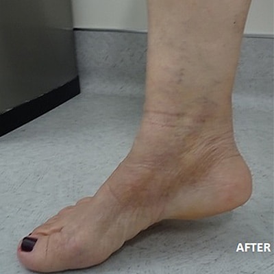 After Image: Spider Vein Treatment - left-side
