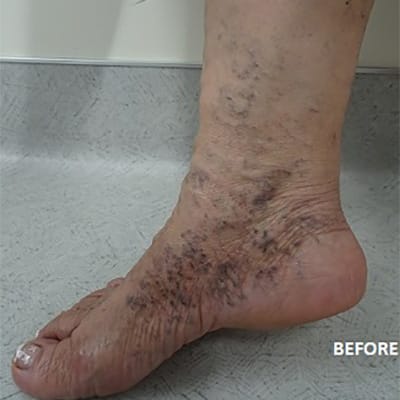 Before Image: Spider Vein Treatment - left-side