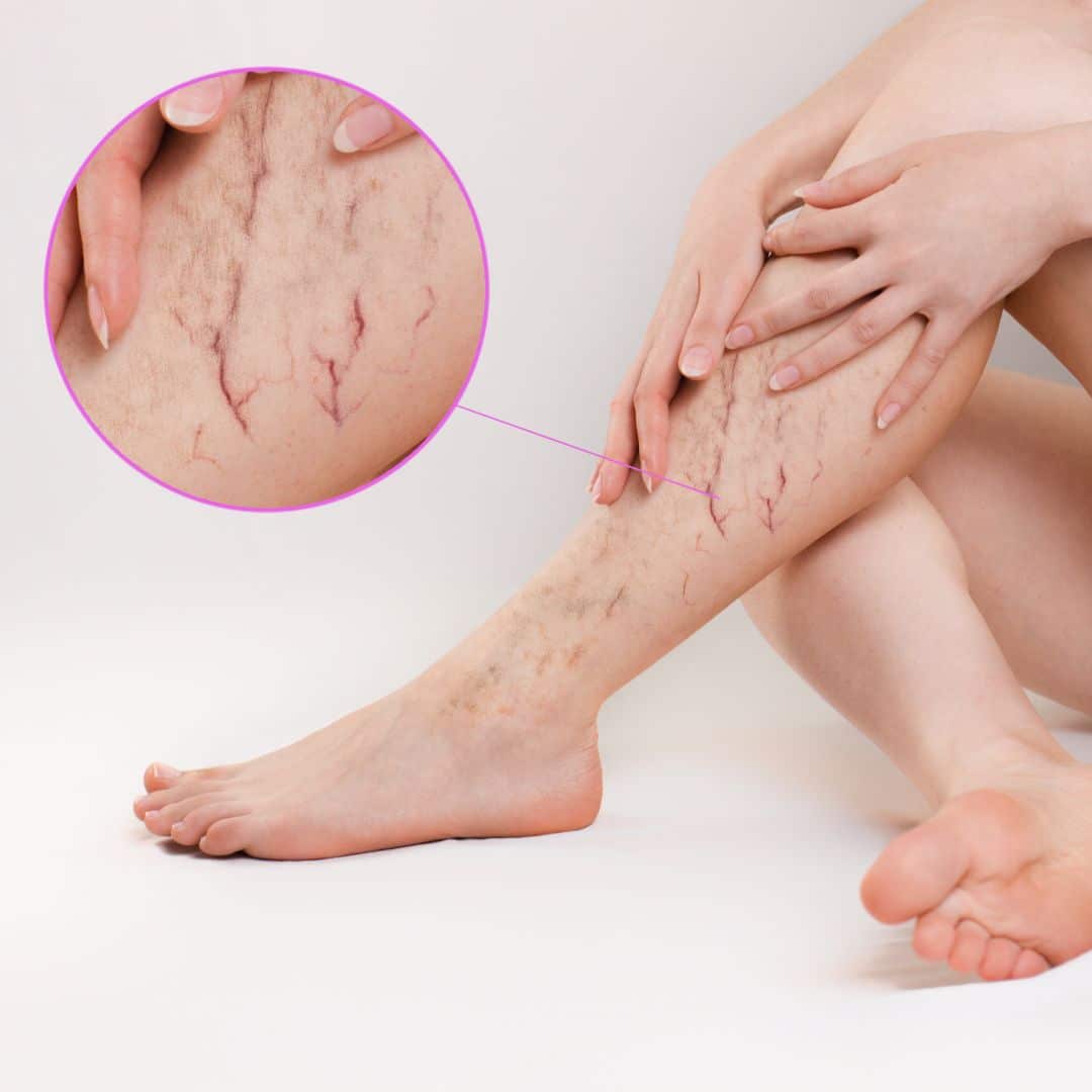 Varicose Veins Treatment Beverly Hills