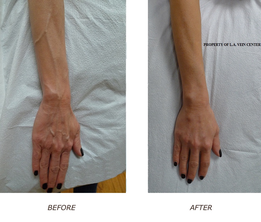 Hand Vein Phlebectomy Before and After treatment LA Vein Center Sherman Oaks Larisse Lee MD 245