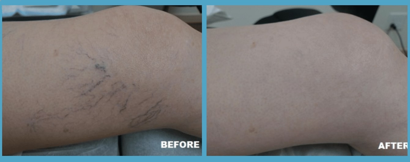 before and after Image of Spider Vein Los Angeles CA