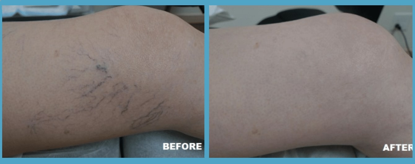 before and after spider vein removal treatment