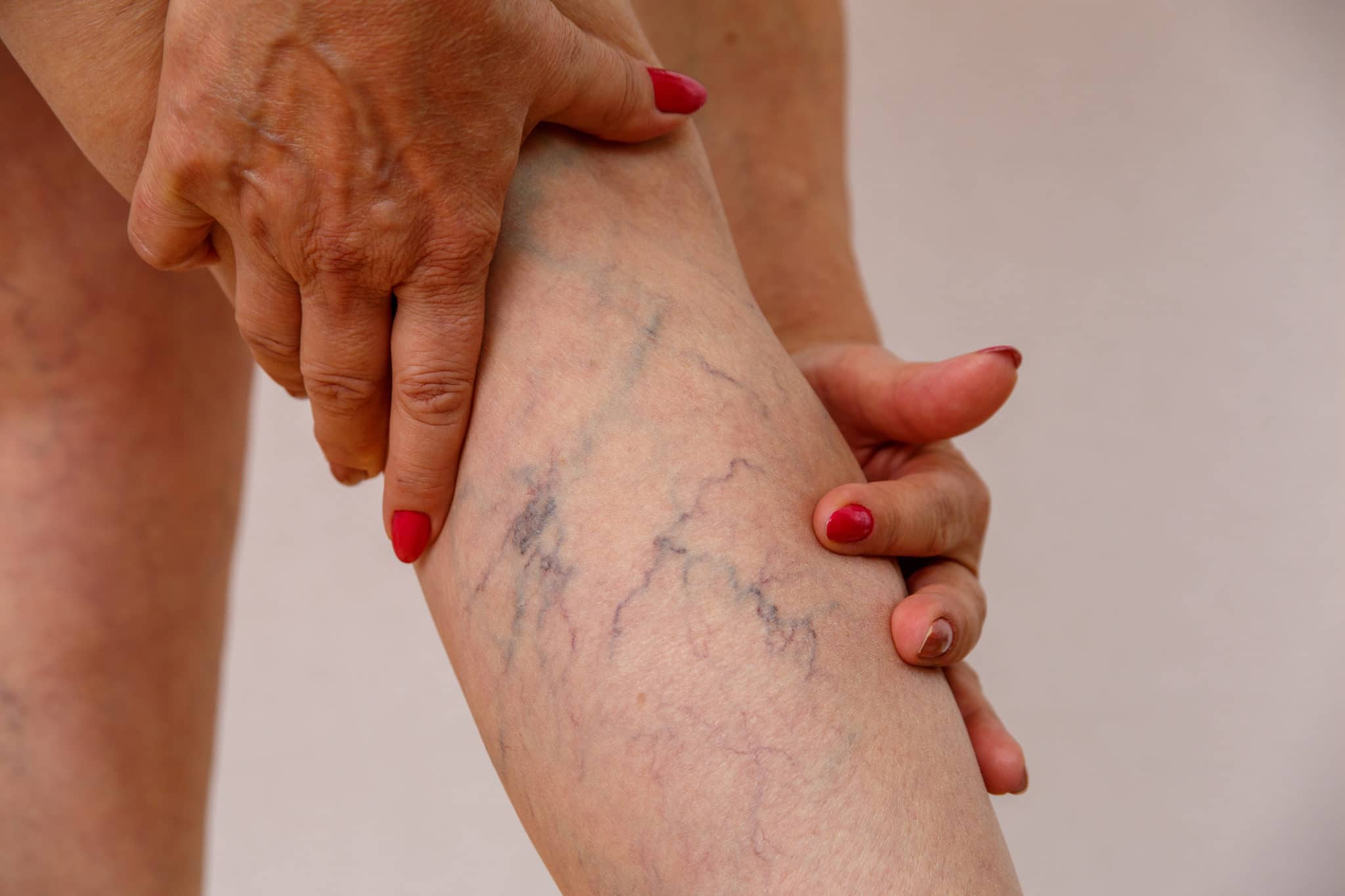 spider varicose veins sclerotherapy los angeles