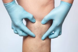 Sclerotherapy Los Angeles