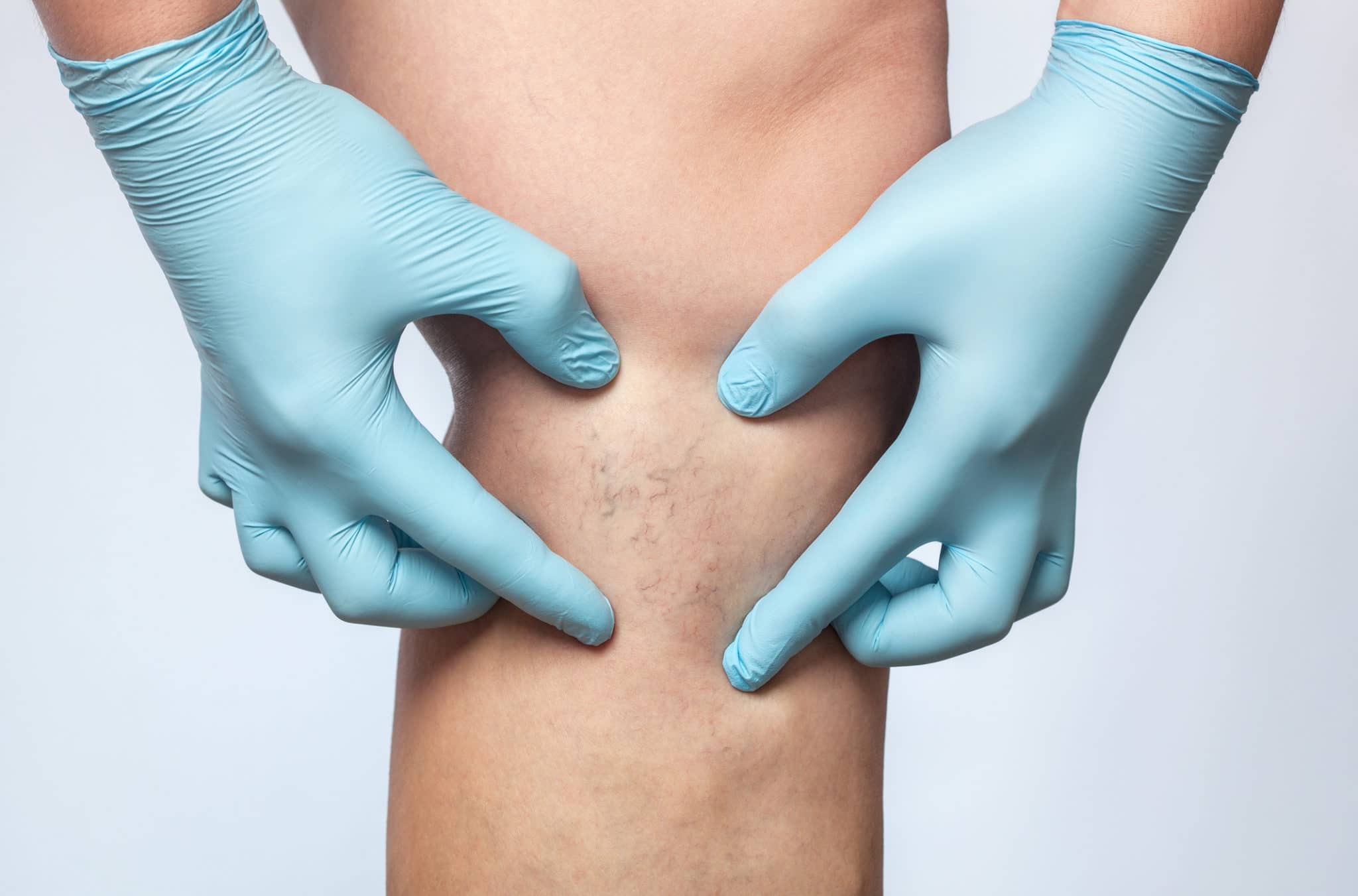 Los angeles sclerotherapy spider veins