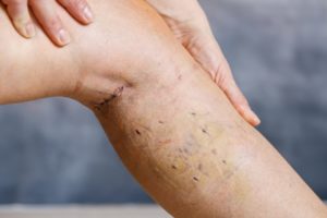 Womans leg after varicose vein surgery, with visible surgical sutures (stitches) and wounds on her leg. Curative treatment, aesthetic procedures, thrombosis prevention and senior health care concept.