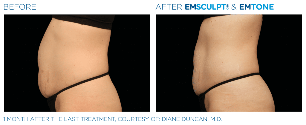 Before & after Image of Emsculpt Neo Los Angeles CA