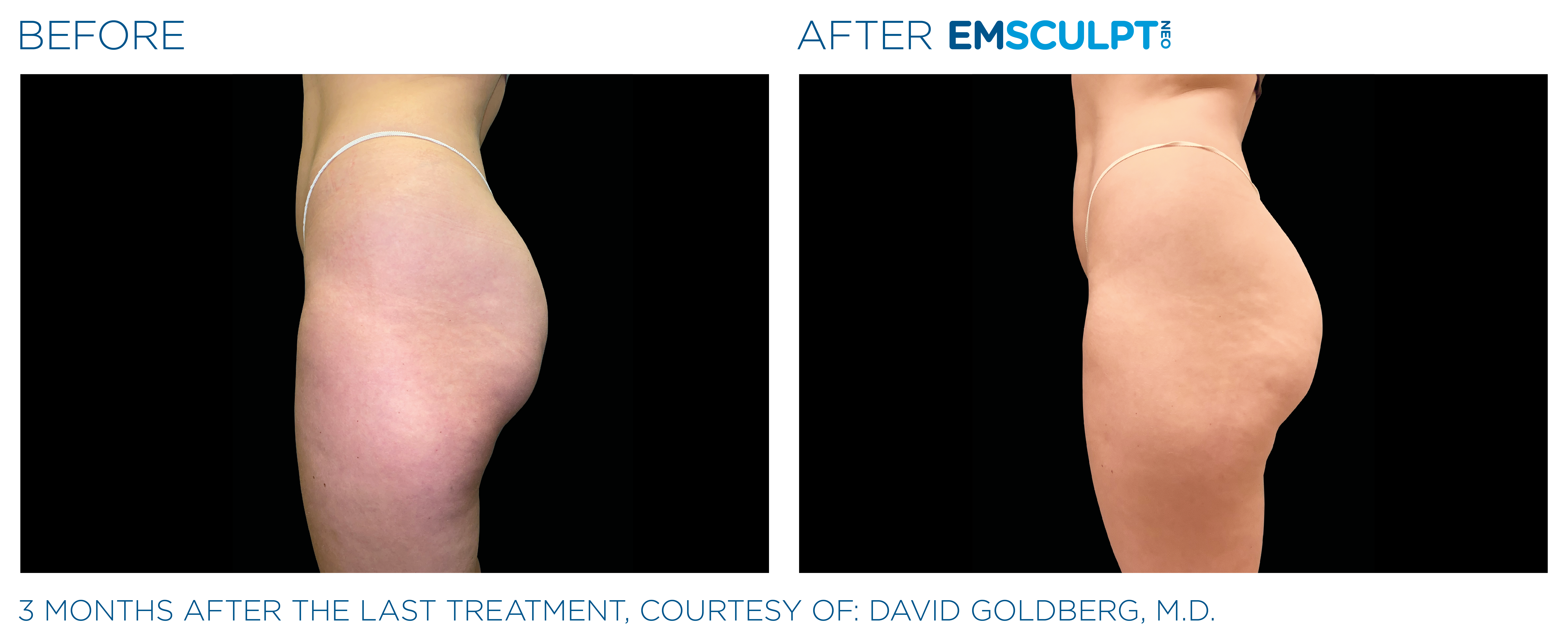 Before & after Image of Emsculpt Neo Treatment Los Angeles CA
