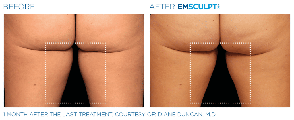 Emsculpt neo PIC Ba card female inner thighs 067 ENUS100