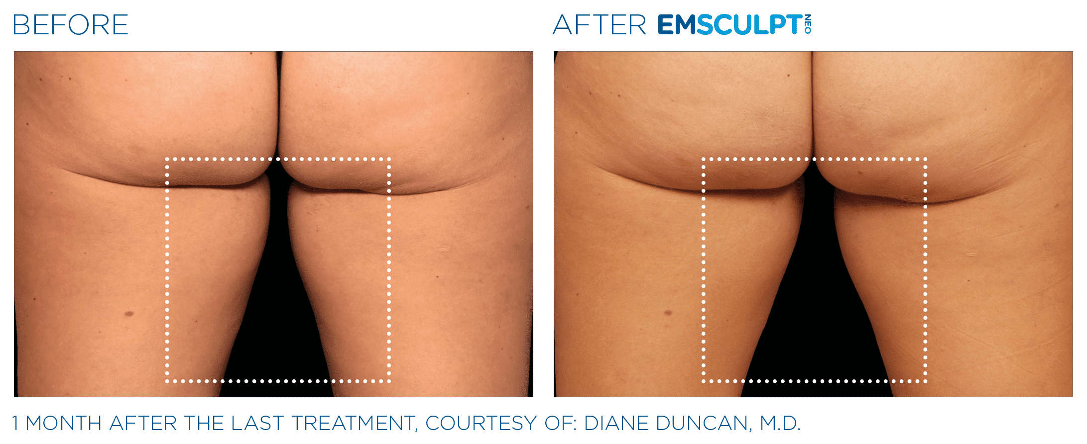 Before & after Image of Emsculpt Neo Therapy Los Angeles CA