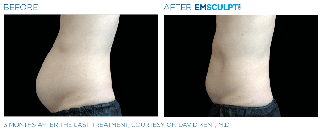 Before & after Image of Emsculpt Neo Los Angeles