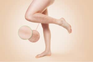 Zoomed image of varicose veins, Before and after treatment.