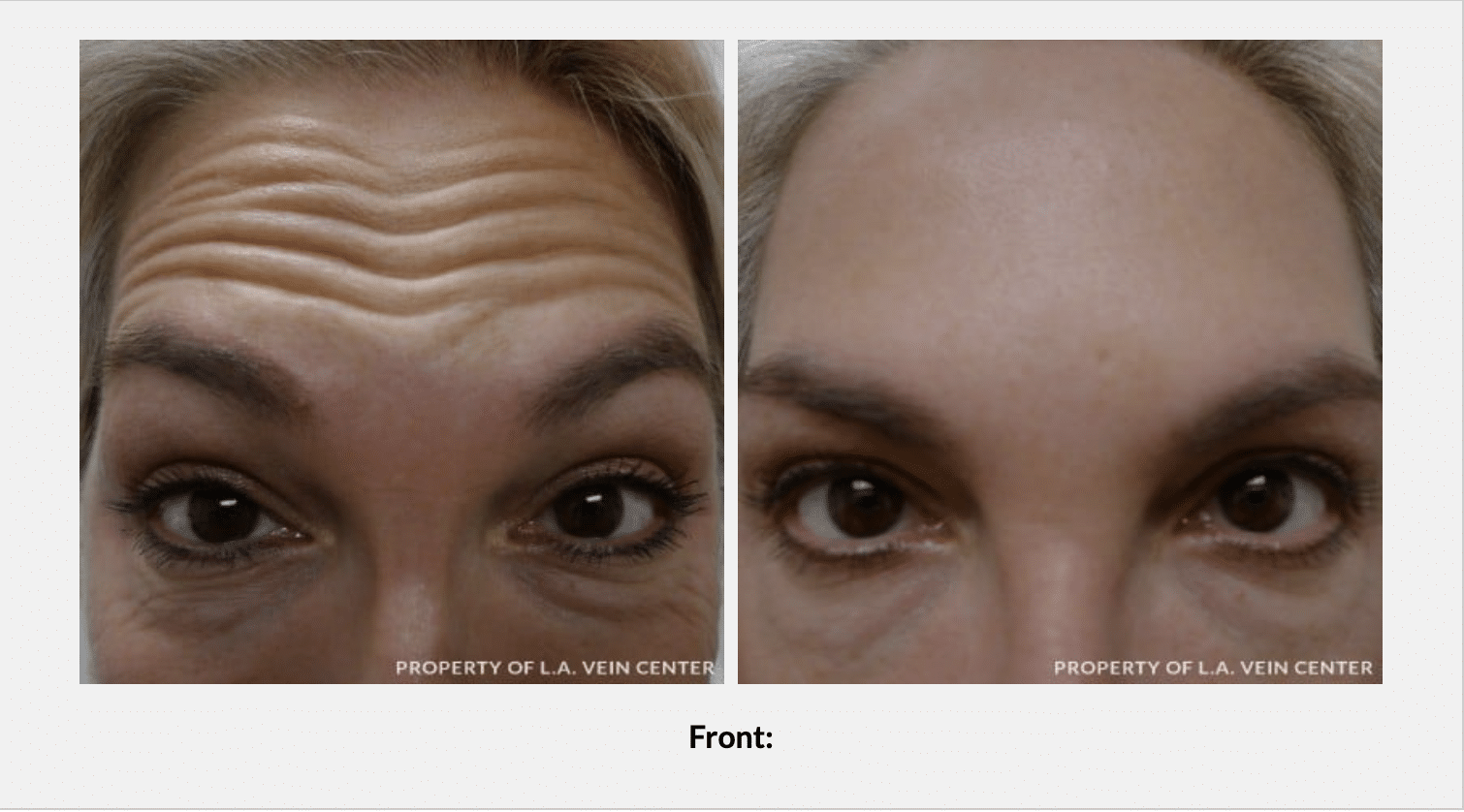 patient's forehead before and after dermal fillers, wrinkles gone after treatment