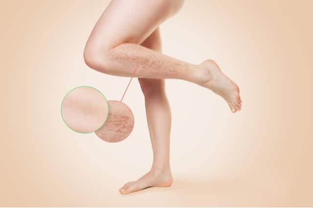 Radiofrequency Ablation Los Angeles CA