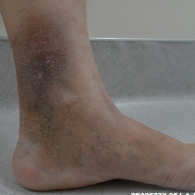 after Image of Leg Ulcer Treatment Los Angeles CA