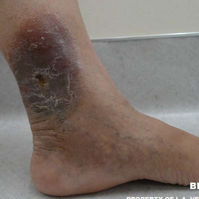 Before Image of Leg Ulcer Treatment Los Angeles CA
