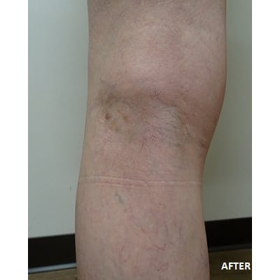 back of leg after spider vein removal treatment much more clear and smooth