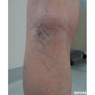 Before Image of Spider Vein Treatment Los Angeles CA