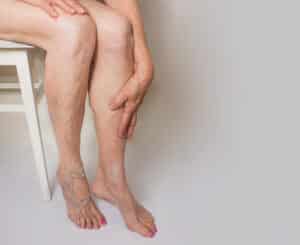 "An image of the lower legs of a woman with visible varicose veins