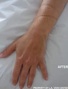 Hand Vein Treatment