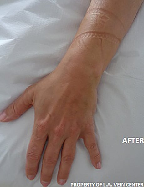 After Image: Hand Vein Treatment - front