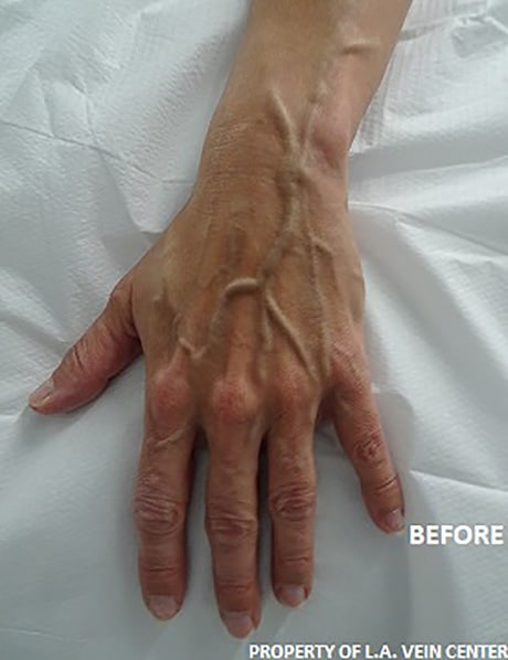 Before Image: Hand Vein Treatment - front