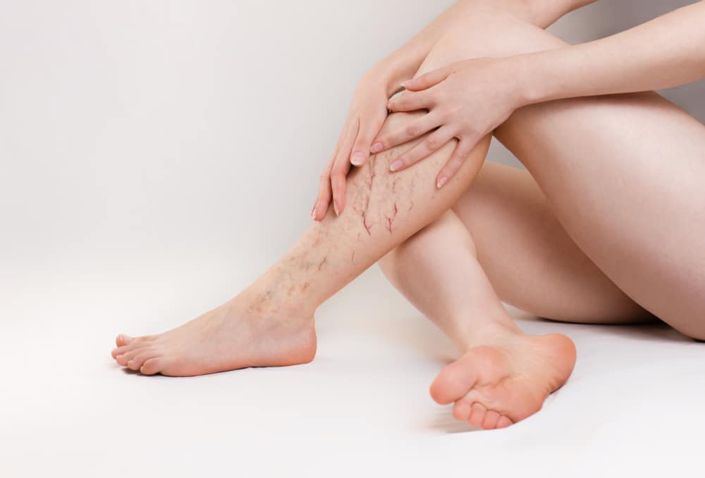 Varicose Veins Treatment Beverly Hills