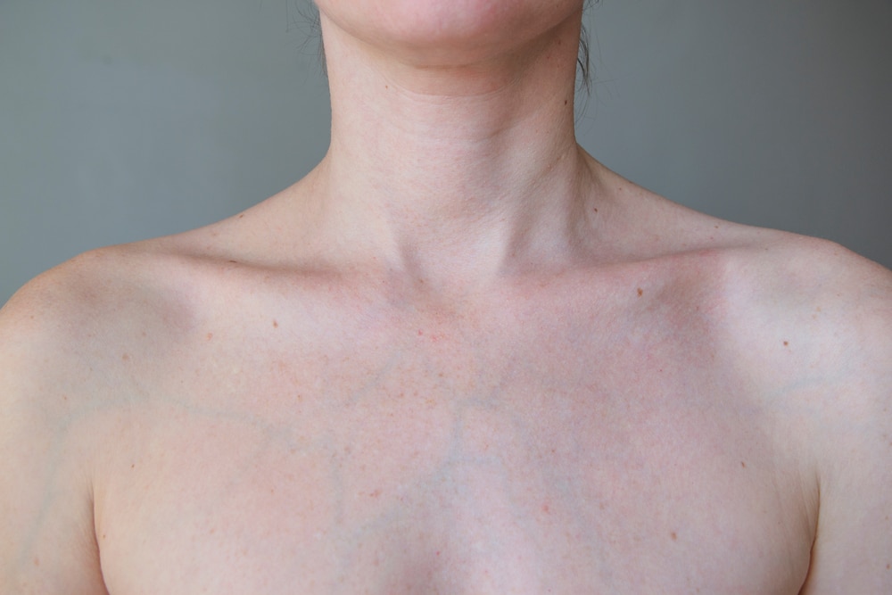 Pigmentation,Of,Spots,On,The,Chest,And,Shoulders