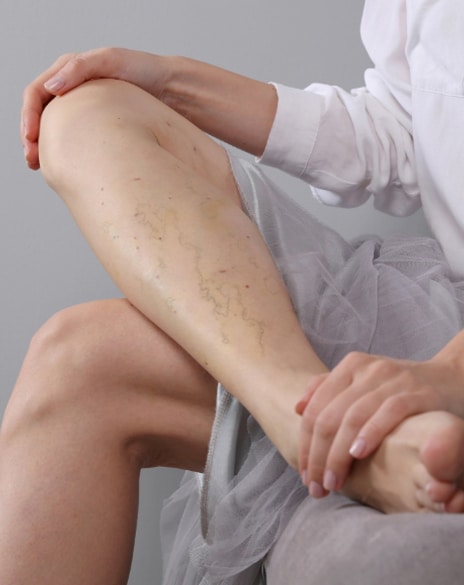 Spider Vein Treatment in Los Angeles