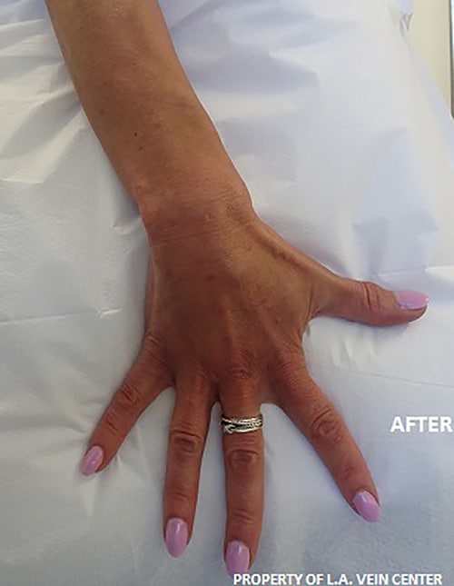 After Image: Hand Treatment - front