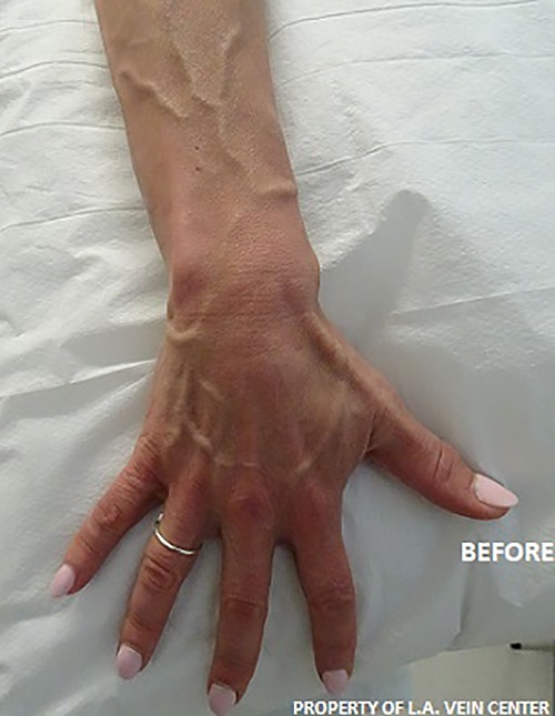 Before Image: Hand Treatment - front