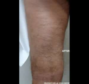 After Image: Radiofrequency Ablation and Phlebectomy