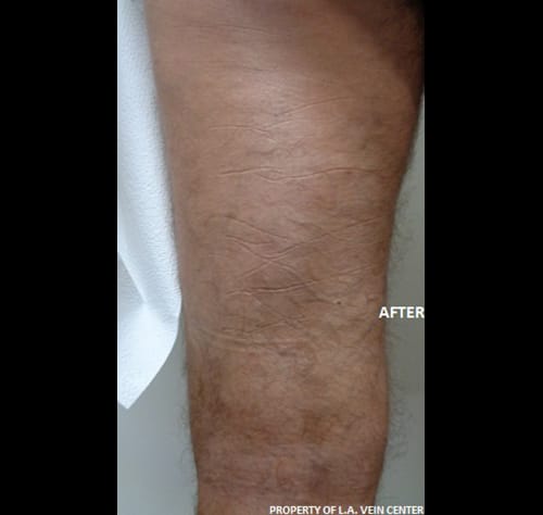 After Image: Radiofrequency Ablation and Phlebectomy - front