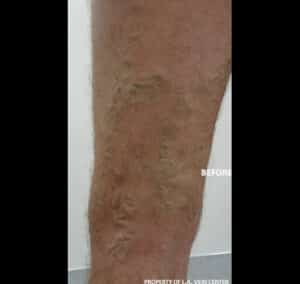 Before Image: Radiofrequency Ablation and Phlebectomy