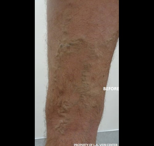 Before Image: Radiofrequency Ablation and Phlebectomy - front