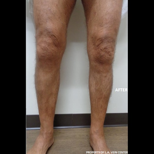 After Image: Radiofrequency Ablation and Phlebectomy - front