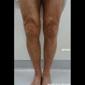 Before Image: Radiofrequency Ablation and Phlebectomy