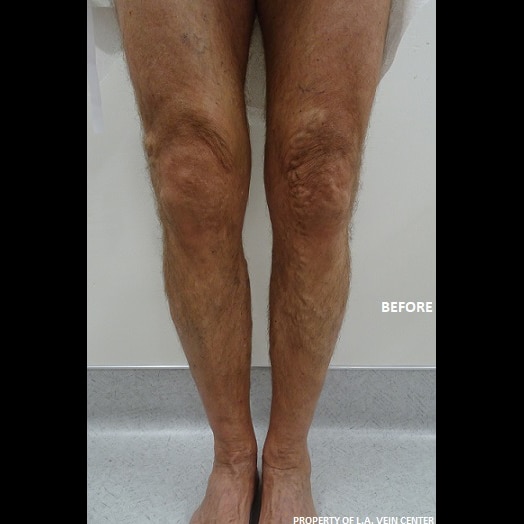Before Image: Radiofrequency Ablation and Phlebectomy - front