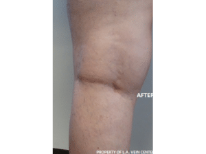 After Image: Spider Vein Treatment
