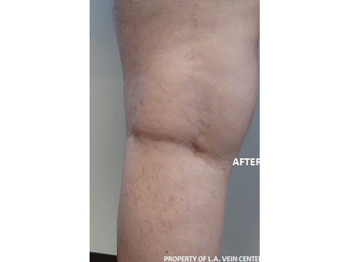 After Image: Spider Vein Treatment - front