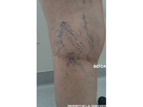 Before Image: Spider Vein Treatment - front