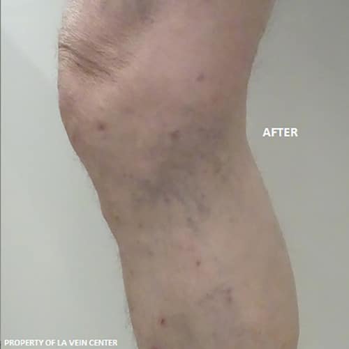 After Image: Varicose Veins - front