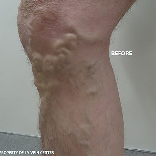 Before Image: Varicose Veins - front