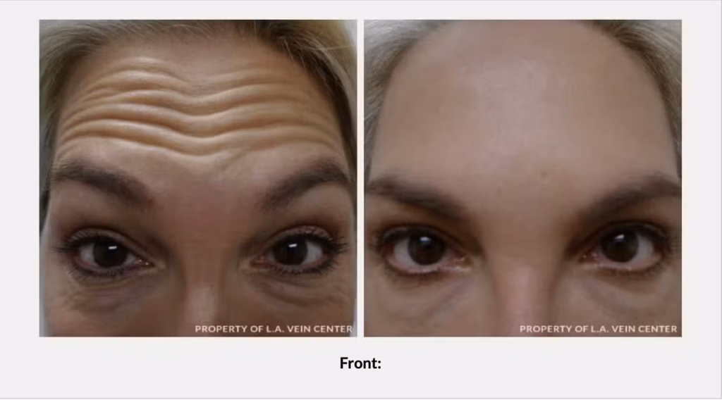 Screen-Shot-2022-03-03-at-1.16.44-PM.png DERMAL FILLERS IN LOS ANGELES, CA