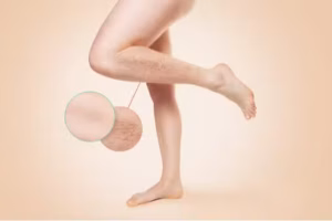 What Do Varicose Veins Tell Me About My Health?
